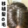 植髪の毛（硬めシリコン材質に限定、軟性シリコンヘッドは対応不可）(+35,000円)